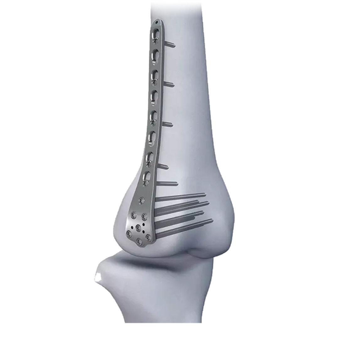 Onkos Surgical Extends NanoCept Antibacterial Tech to Femoral Implants